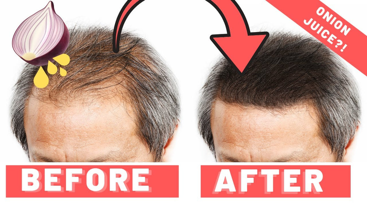ONION JUICE FOR HAIR GROWTH